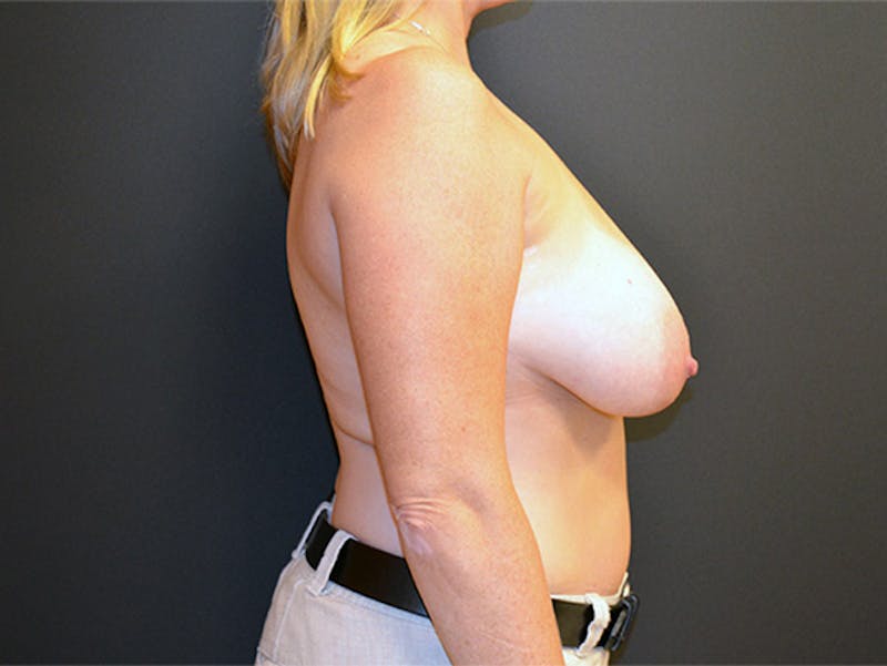 Breast Lift Before & After Gallery - Patient 167355571 - Image 5