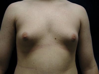 Breast Gynecomastia Before & After Gallery - Patient 167355568 - Image 1