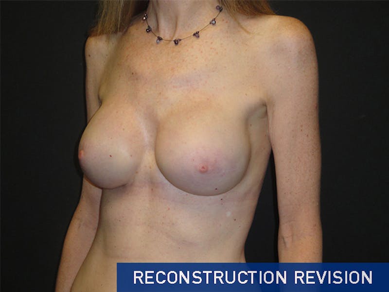 Breast Revision Before & After Gallery - Patient 167355559 - Image 8