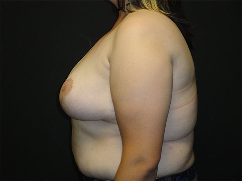 Breast Asymmetry Correction Before & After Gallery - Patient 167355560 - Image 6