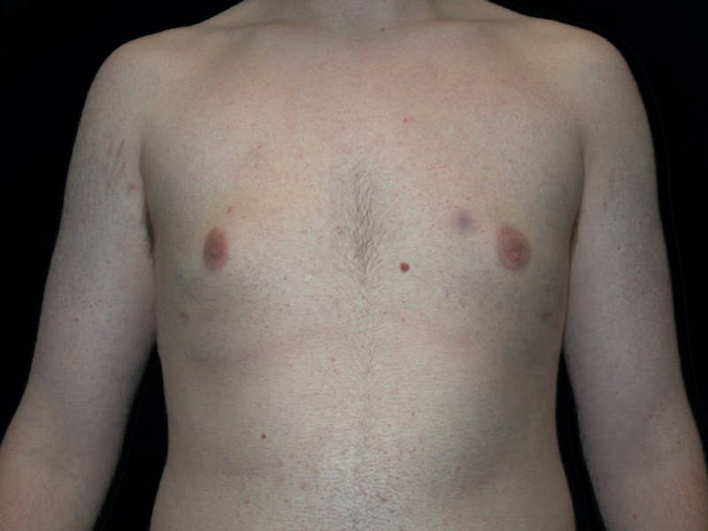 Breast Gynecomastia Before & After Gallery - Patient 167355568 - Image 2
