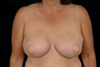Breast Flap Reconstruction Before & After Gallery - Patient 167355570 - Image 2