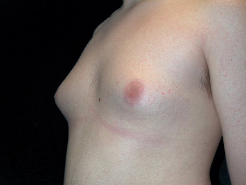 Breast Gynecomastia Before & After Gallery - Patient 167355568 - Image 3