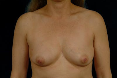 Breast Asymmetry Correction Before & After Gallery - Patient 167355567 - Image 1