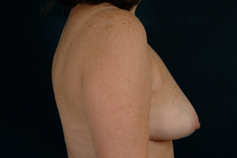 Breast Flap Reconstruction Before & After Gallery - Patient 167355570 - Image 3