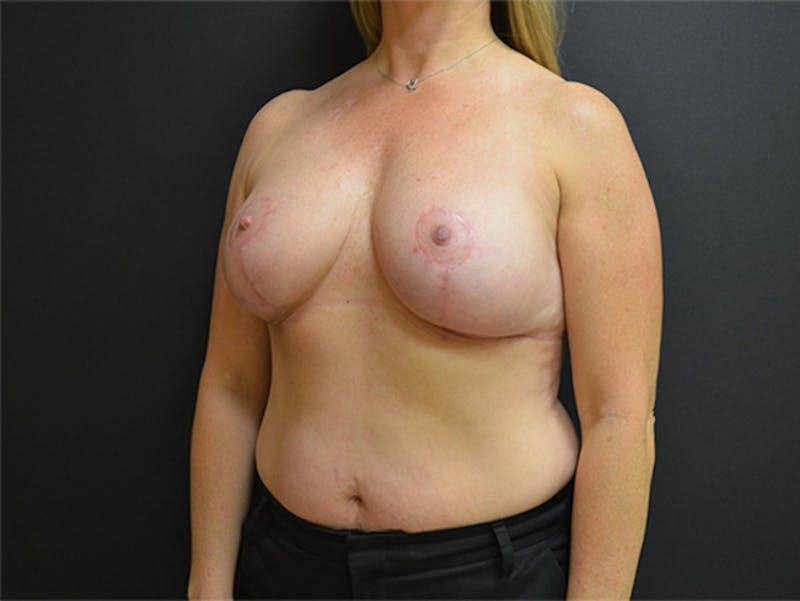 Breast Lift Before & After Gallery - Patient 167355571 - Image 8