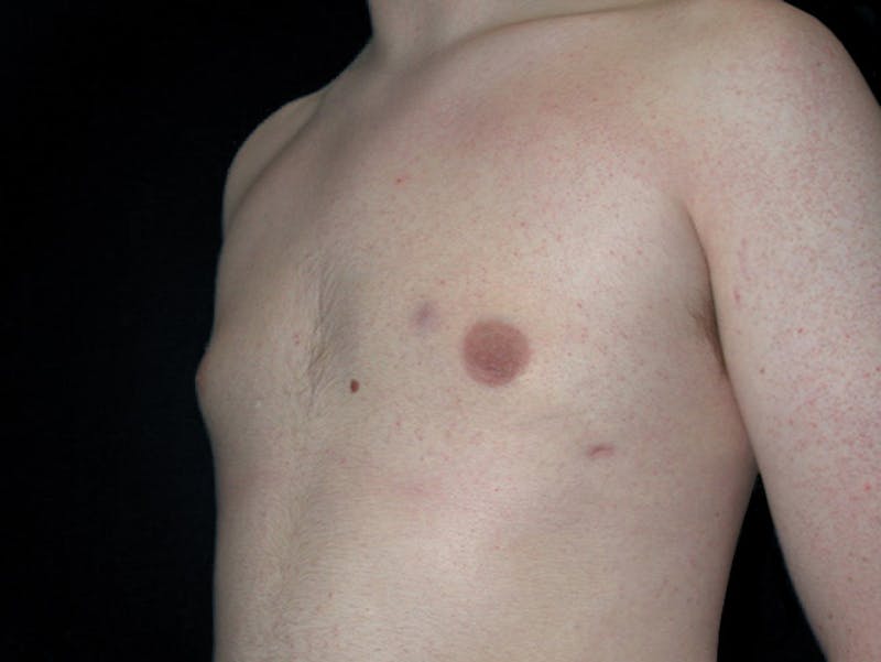 Breast Gynecomastia Before & After Gallery - Patient 167355568 - Image 4