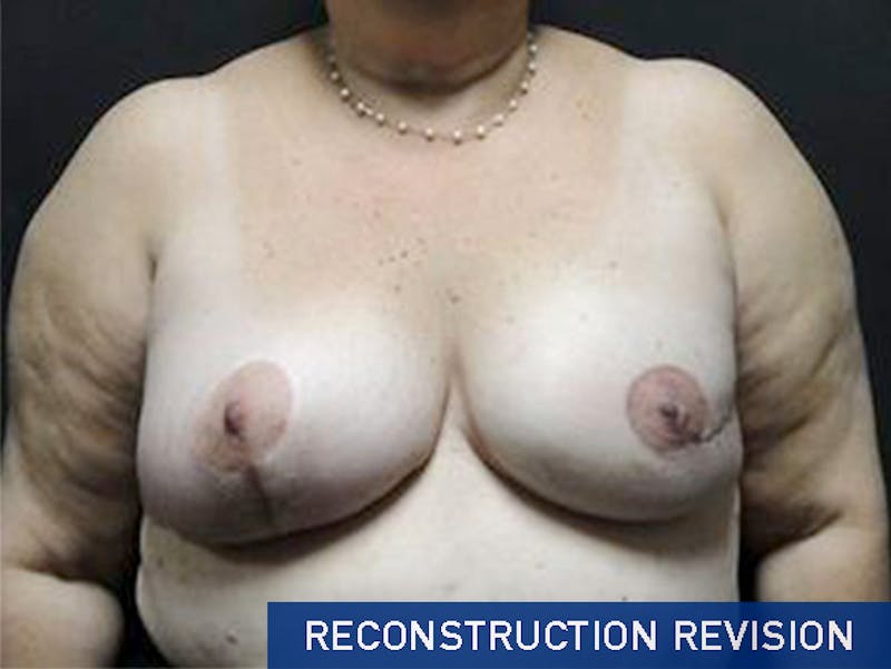 Breast Revision Before & After Gallery - Patient 167355572 - Image 2