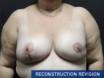Breast Revision Before & After Gallery - Patient 167355572 - Image 2