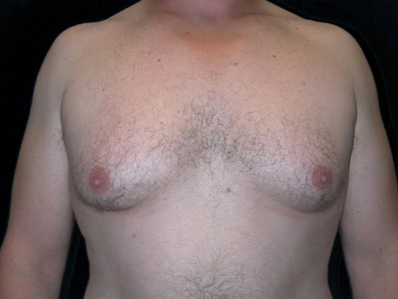 Breast Gynecomastia Before & After Gallery - Patient 167355586 - Image 1