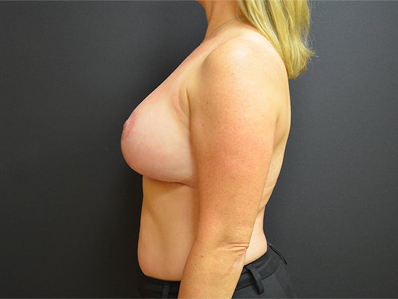 Breast Lift Before & After Gallery - Patient 167355571 - Image 10