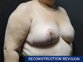 Breast Revision Before & After Gallery - Patient 167355572 - Image 4