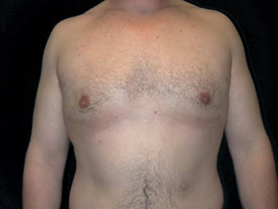 Breast Gynecomastia Before & After Gallery - Patient 167355586 - Image 2