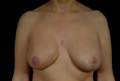 Breast Flap Reconstruction Before & After Gallery - Patient 167355587 - Image 2