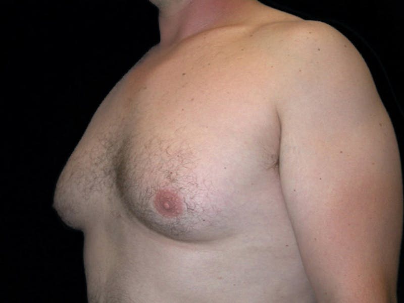 Breast Gynecomastia Before & After Gallery - Patient 167355586 - Image 3