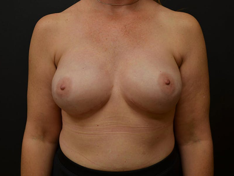 Breast Implant Reconstruction Before & After Gallery - Patient 167355583 - Image 2