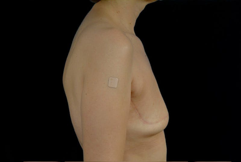 Breast Flap Reconstruction Before & After Gallery - Patient 167355587 - Image 3