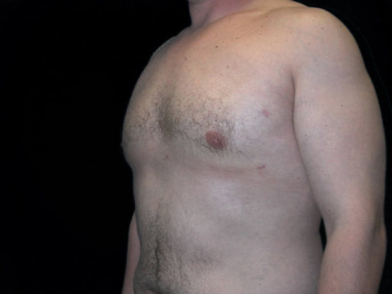Breast Gynecomastia Before & After Gallery - Patient 167355586 - Image 4