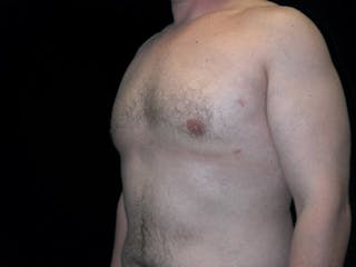 Breast Gynecomastia Before & After Gallery - Patient 167355586 - Image 4
