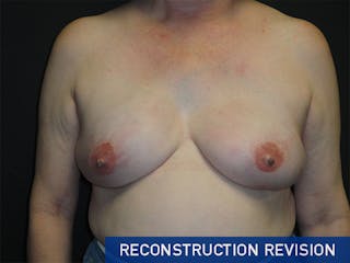 Breast Revision Before & After Gallery - Patient 167355592 - Image 2