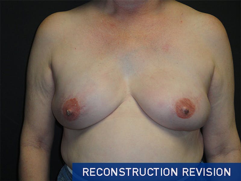 Breast Revision Before & After Gallery - Patient 167355592 - Image 2