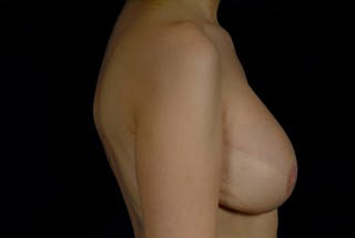 Breast Flap Reconstruction Before & After Gallery - Patient 167355587 - Image 4