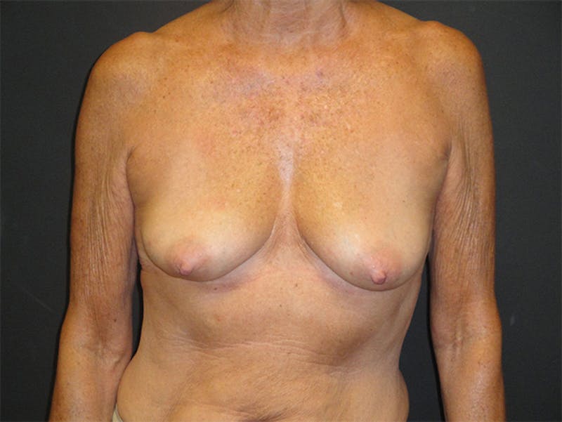 Breast Implant Reconstruction Before & After Gallery - Patient 167355598 - Image 1