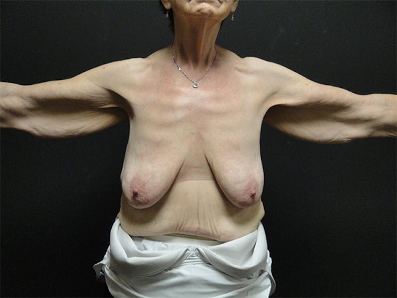 Breast Lift Before & After Gallery - Patient 167355588 - Image 1
