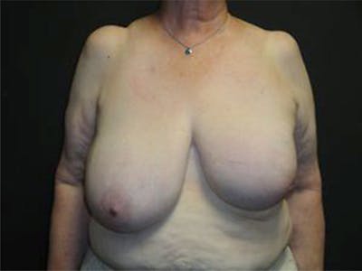 Breast Asymmetry Correction Before & After Gallery - Patient 167355589 - Image 1