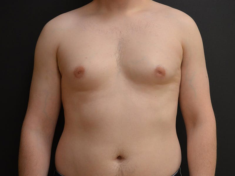 Breast Gynecomastia Before & After Gallery - Patient 167355591 - Image 1