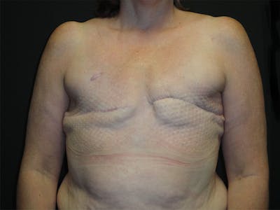 Breast Flap Reconstruction Before & After Gallery - Patient 167355599 - Image 1
