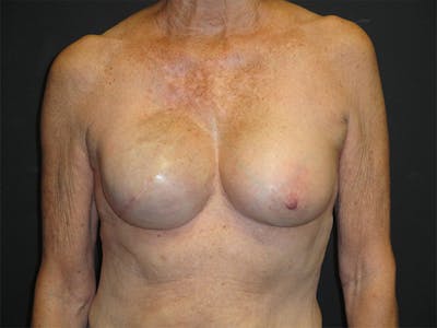 Breast Implant Reconstruction Before & After Gallery - Patient 167355598 - Image 2