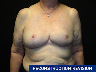 Breast Asymmetry Correction Before & After Gallery - Patient 167355589 - Image 2