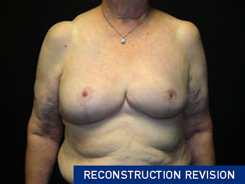 Breast Asymmetry Correction Before & After Gallery - Patient 167355589 - Image 2
