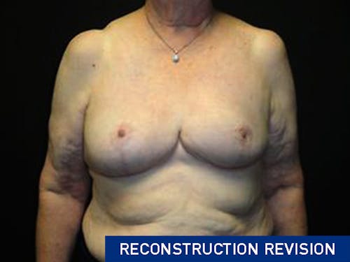 Breast Asymmetry Correction Scottsdale & Phoenix