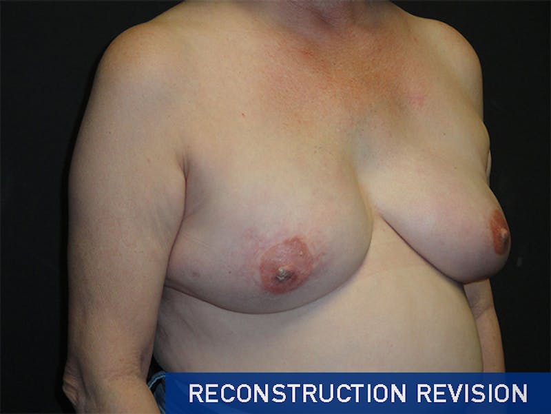 Breast Revision Before & After Gallery - Patient 167355592 - Image 4