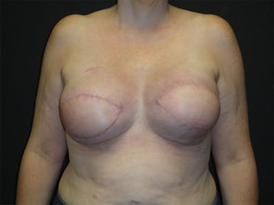 Breast Flap Reconstruction Before & After Gallery - Patient 167355599 - Image 2