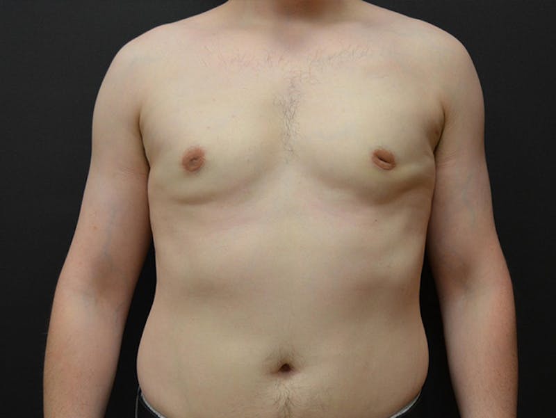 Breast Gynecomastia Before & After Gallery - Patient 167355591 - Image 2