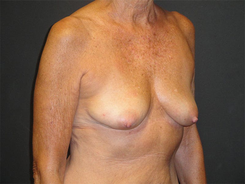 Breast Implant Reconstruction Before & After Gallery - Patient 167355598 - Image 3