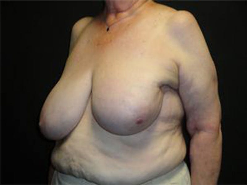 Breast Asymmetry Correction Before & After Gallery - Patient 167355589 - Image 3