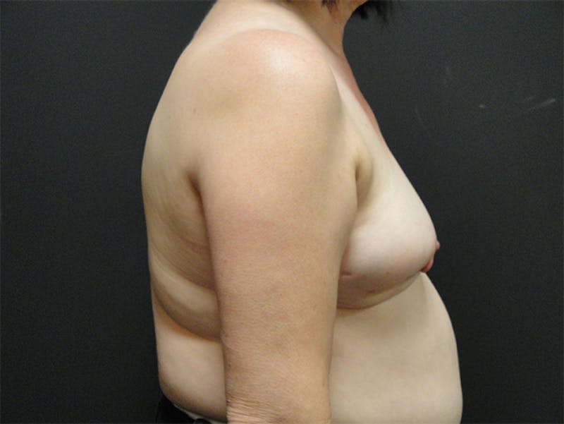 Breast Revision Before & After Gallery - Patient 167355592 - Image 5