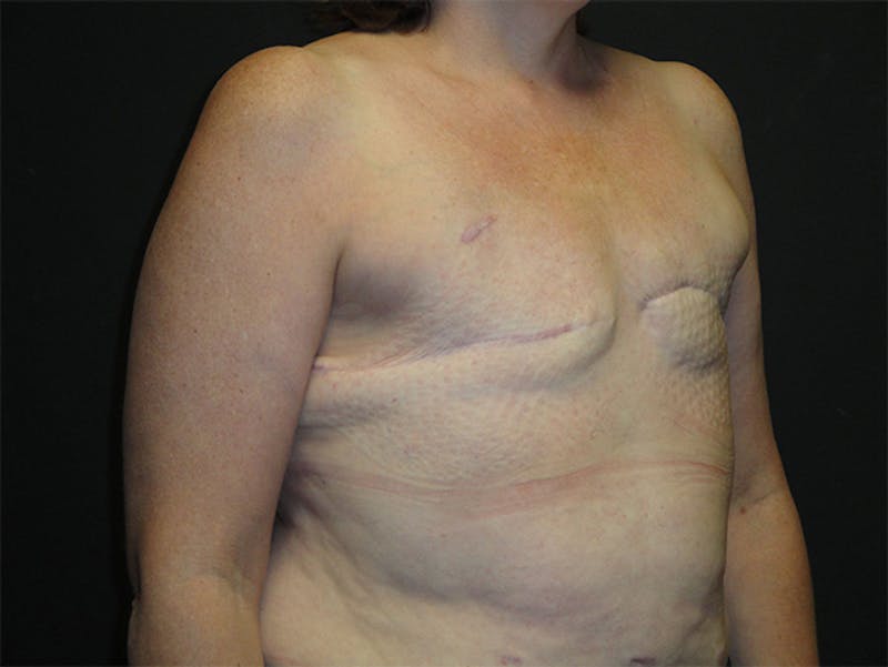 Breast Flap Reconstruction Before & After Gallery - Patient 167355599 - Image 3