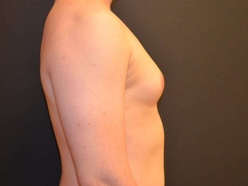 Breast Gynecomastia Before & After Gallery - Patient 167355591 - Image 3