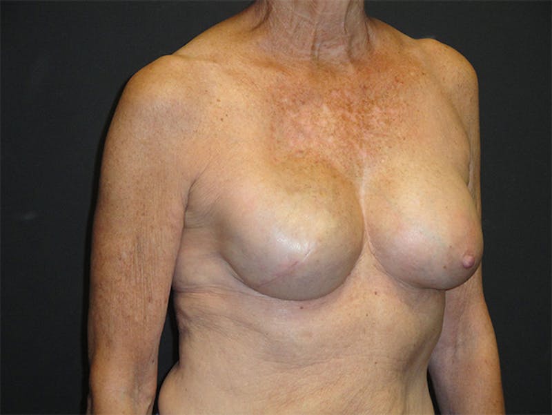 Breast Implant Reconstruction Before & After Gallery - Patient 167355598 - Image 4