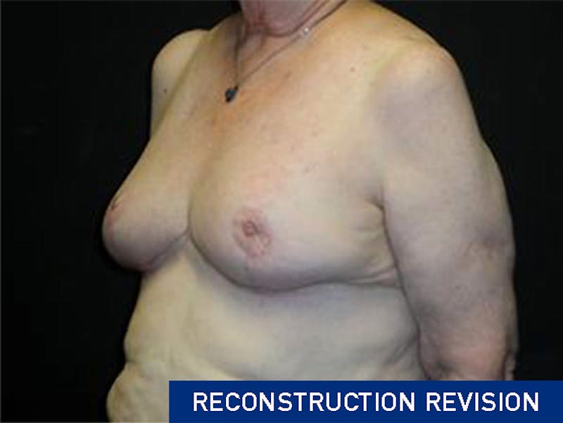 Breast Asymmetry Correction Before & After Gallery - Patient 167355589 - Image 4