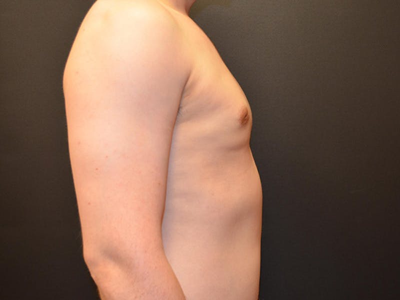 Breast Gynecomastia Before & After Gallery - Patient 167355591 - Image 4