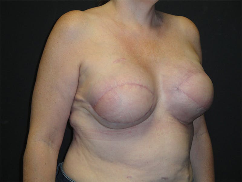Breast Flap Reconstruction Before & After Gallery - Patient 167355599 - Image 4