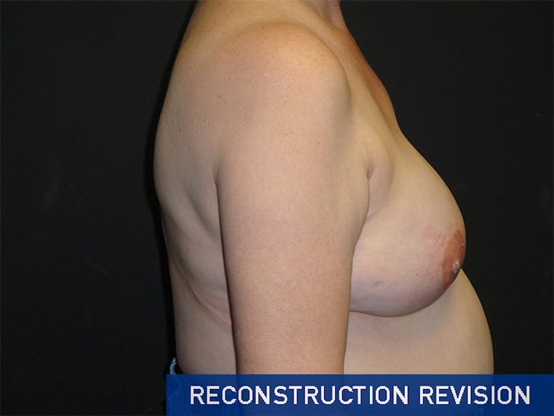 Breast Revision Before & After Gallery - Patient 167355592 - Image 6