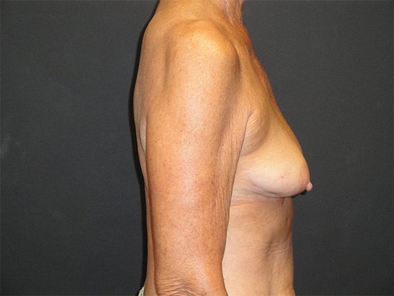 Breast Implant Reconstruction Before & After Gallery - Patient 167355598 - Image 5