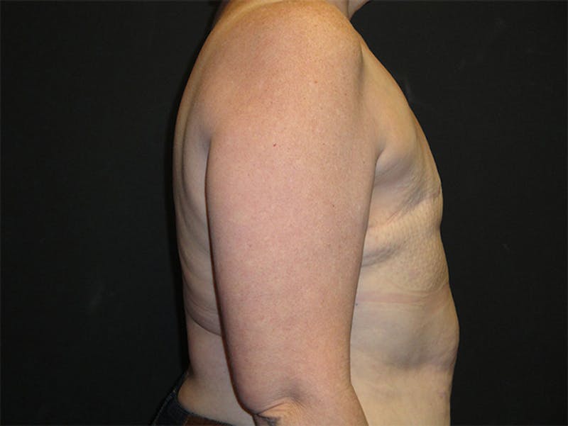 Breast Flap Reconstruction Before & After Gallery - Patient 167355599 - Image 5